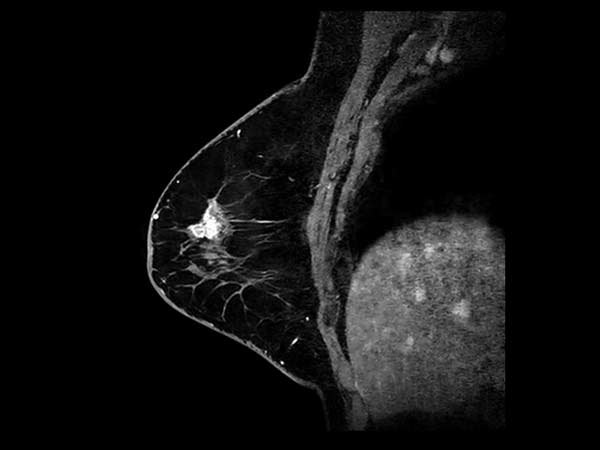 Sagittal 3D mDIXON gado (MPR)