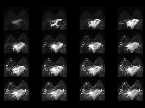 Dynamic T1w TFE (MIP)