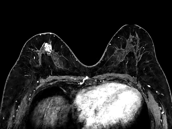 Axial 3D mDIXON gado (MPR)