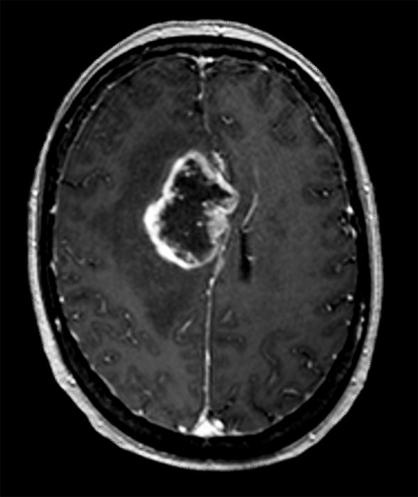 Axial T1w 3D FFE with gado