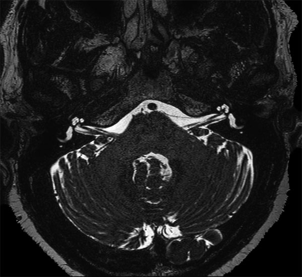 Axial T2w DRIVE 3D SENSE = 3