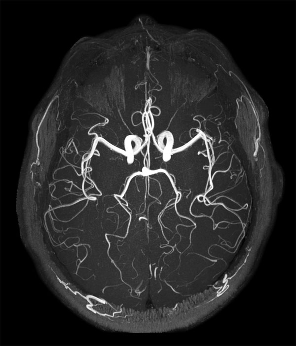 MRA Inflow SENSE = 3
