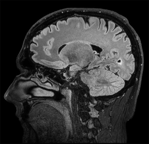 Sagittal BrainVIEW FLAIR SENSE = 9
