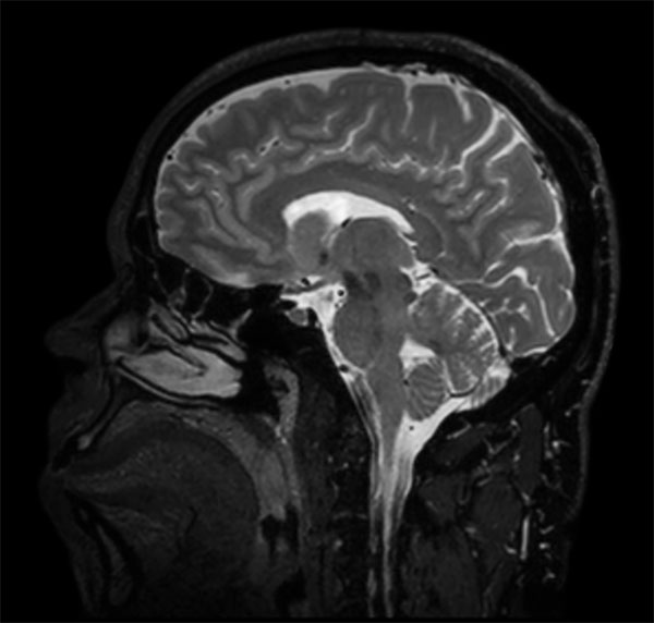Sagittal BrainVIEW T2w SENSE = 9
