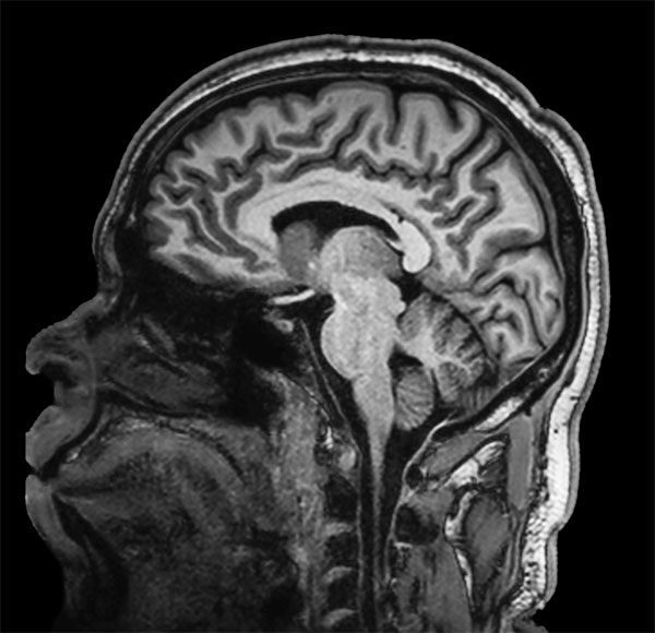 Sagittal T1w TFE 3D SENSE = 9