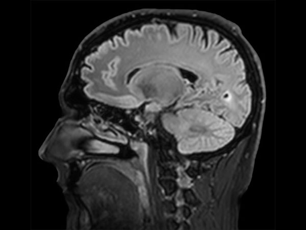 Sagittal BrainVIEW FLAIR SENSE = 3