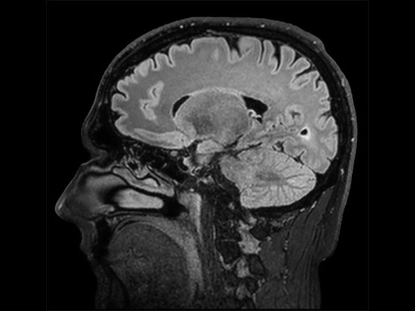 Sagittal BrainVIEW FLAIR SENSE = 9