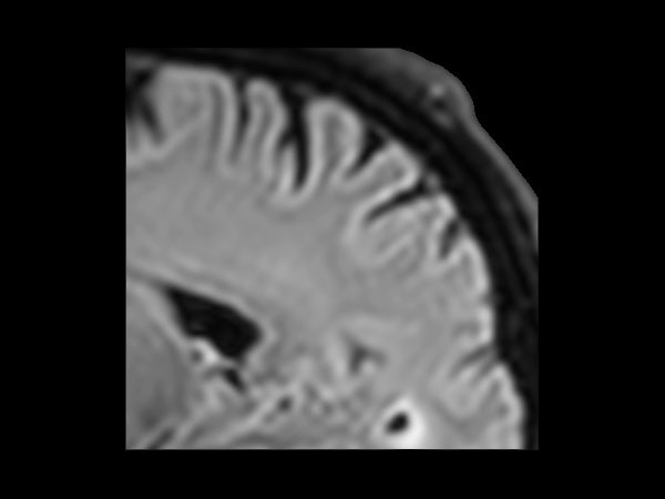 Sagittal BrainVIEW FLAIR SENSE = 3