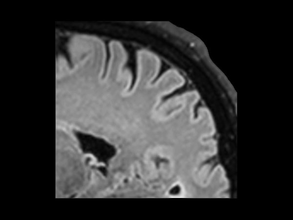 Sagittal BrainVIEW FLAIR SENSE = 9