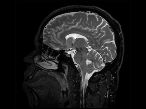 Sagittal BrainVIEW T2w SENSE = 9