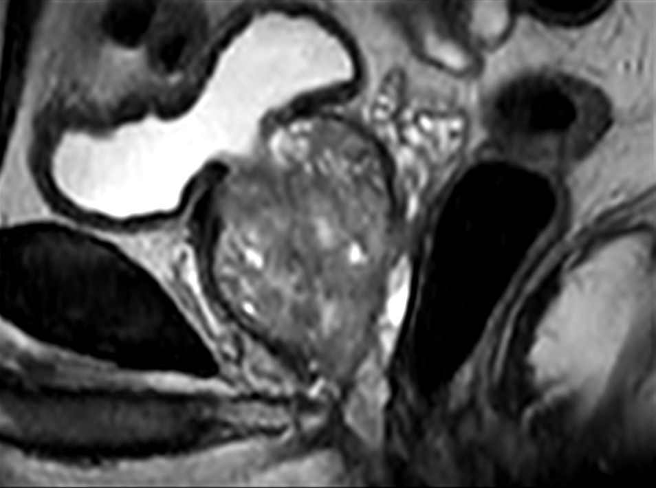 Sagittal 3D VIEW T2w (MPR)