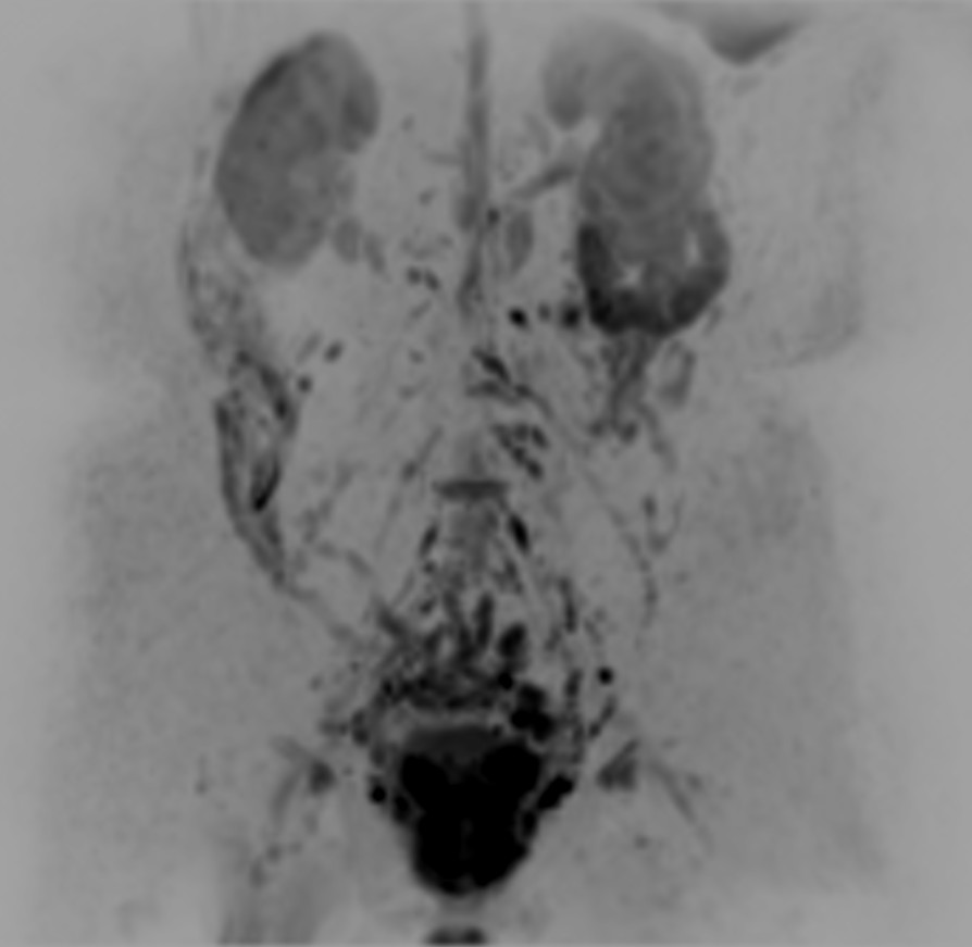Coronal DWIBS b1000 (MIP)