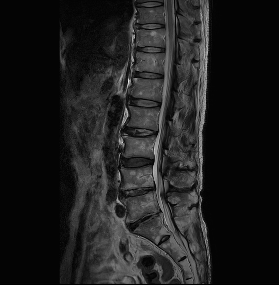 Sagittal T2w TSE