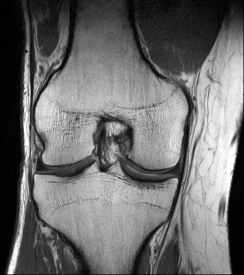 Coronal T1w TSE DRIVE