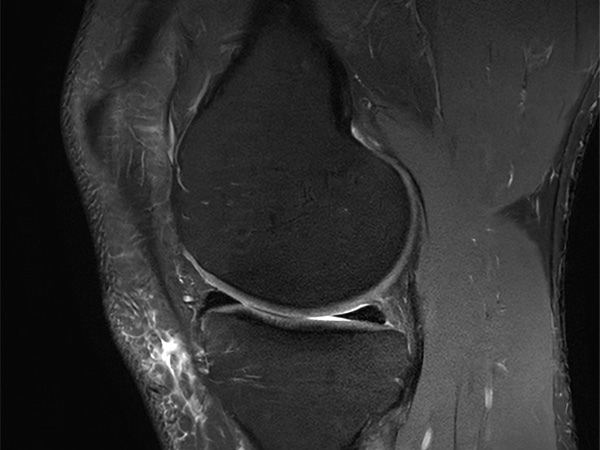 Sagittal PDw FatSat