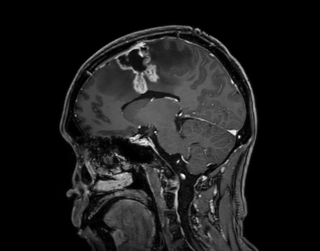 Sagittal 3D T1w TFE gado