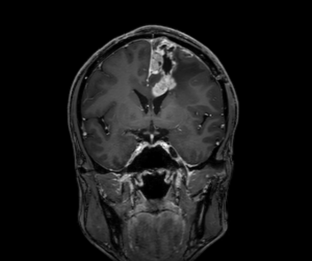 Coronal 3D T1w TFE (MPR) gado