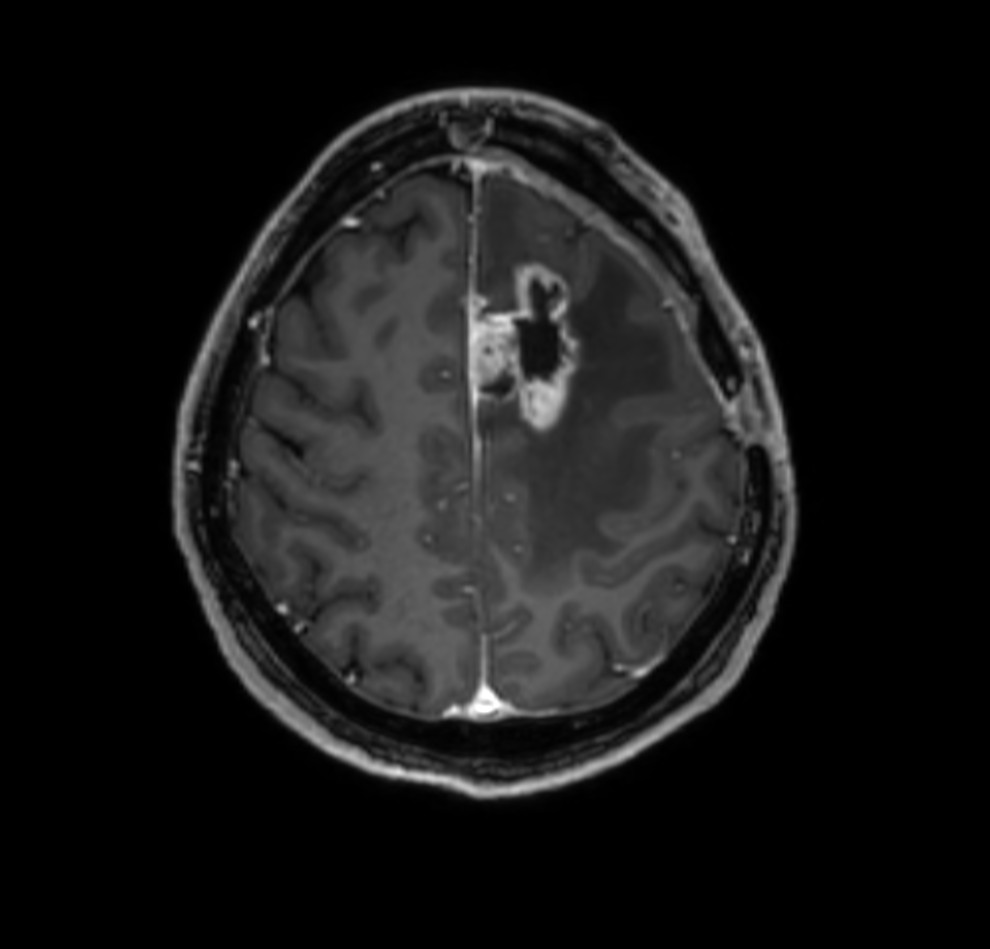 Axial 3D T1w TFE (MPR) gado