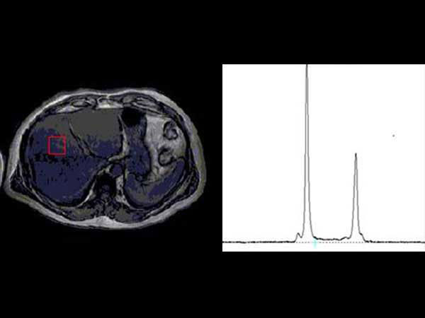 Fat fraction by MRS: 17.8% ± 2.7%