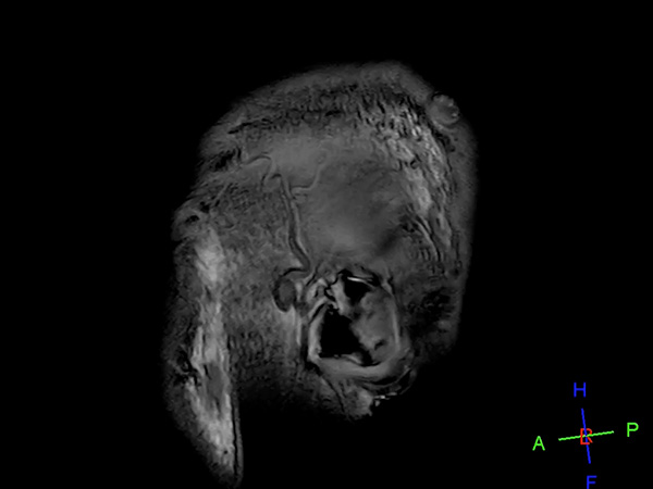 Sagittal T1w 3D TFE