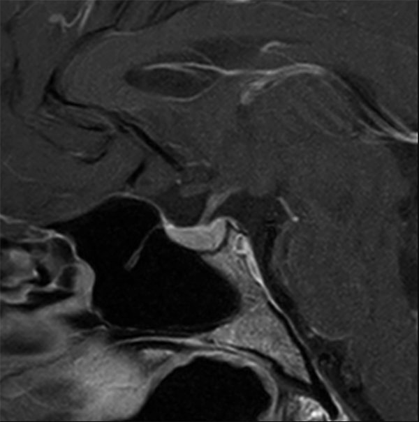 Sagittal T1w TSE (+gado)