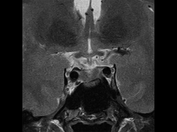 Coronal T2w TSE