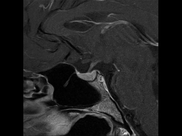 Sagittal T1w TSE (+gado)