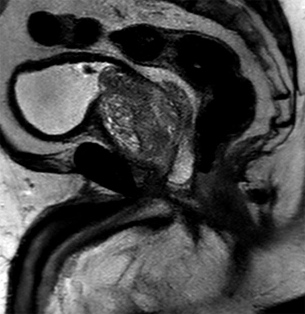 Sagittal SSh T2w TSE