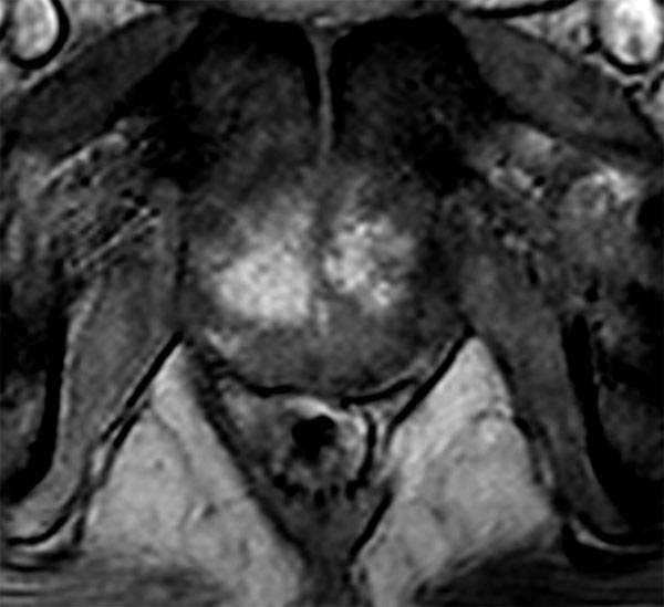 Axial dynamic T1w 3D TFE