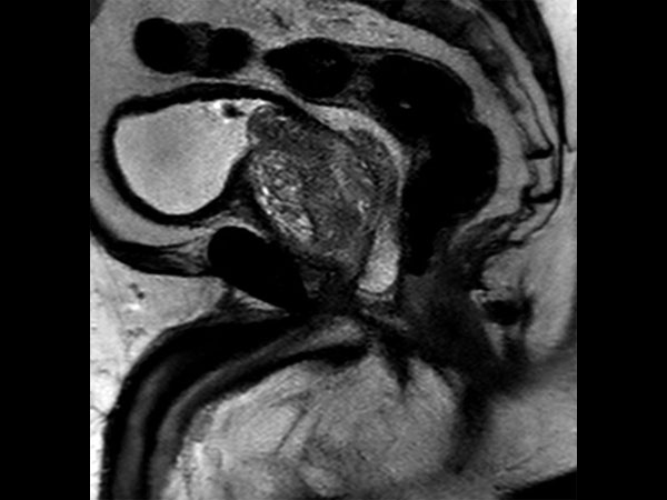 Sagittal SSh T2w TSE