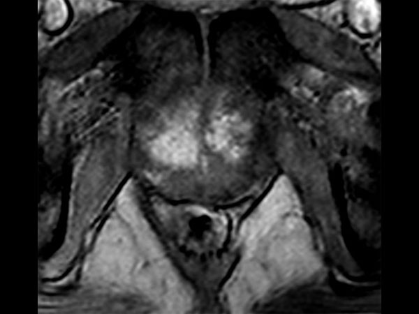 Axial dynamic T1w 3D TFE