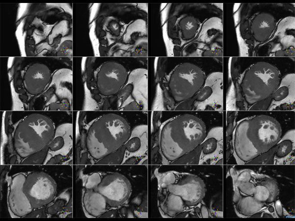 bTFE M2D Cine Imaging