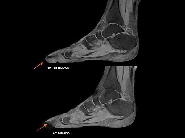 T1W TSE (mDIXON and SPIR)