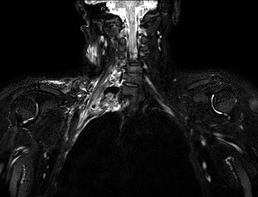 Coronal 3D NerveVIEW