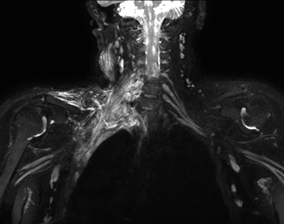 Coronal 3D NerveVIEW (MIP)
