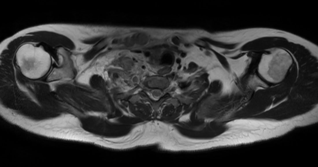 Axial T2w mDIXON XD TSE (In Phase)