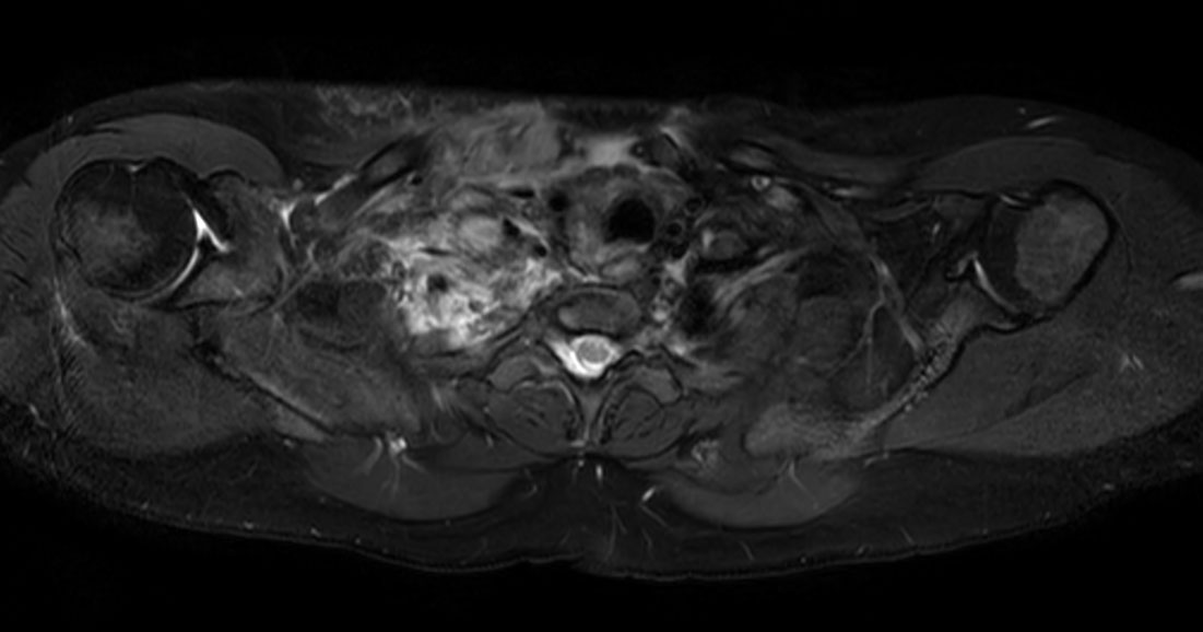 Axial T2w mDIXON XD TSE (Water only)