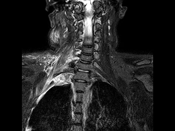 Coronal STIR TSE