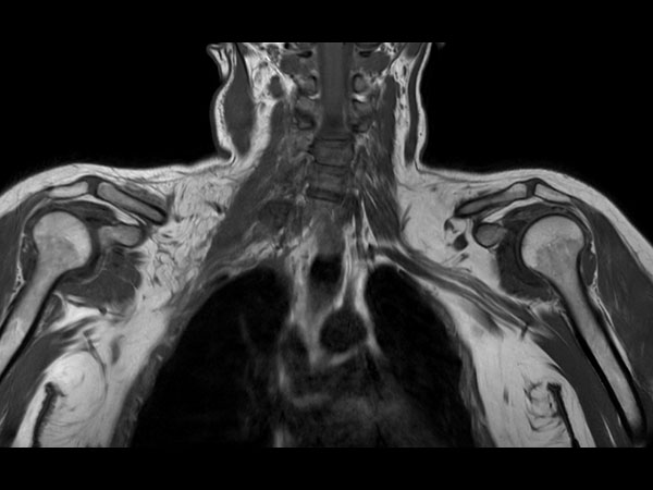 Coronal T1w TSE