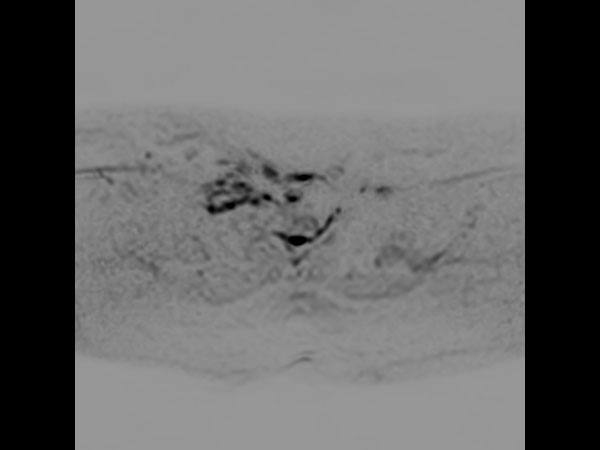 Axial DWIBS (MIP)