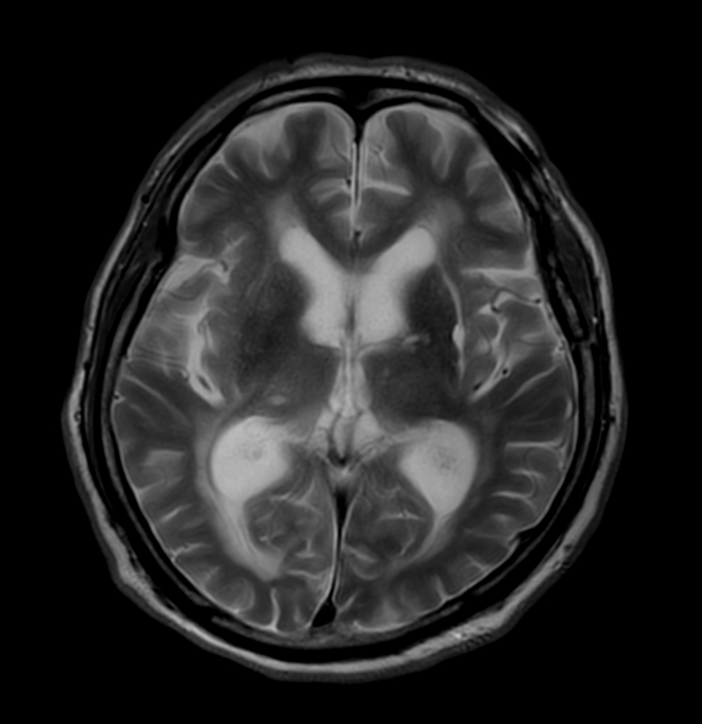 T2w TSE - MultiVane XD