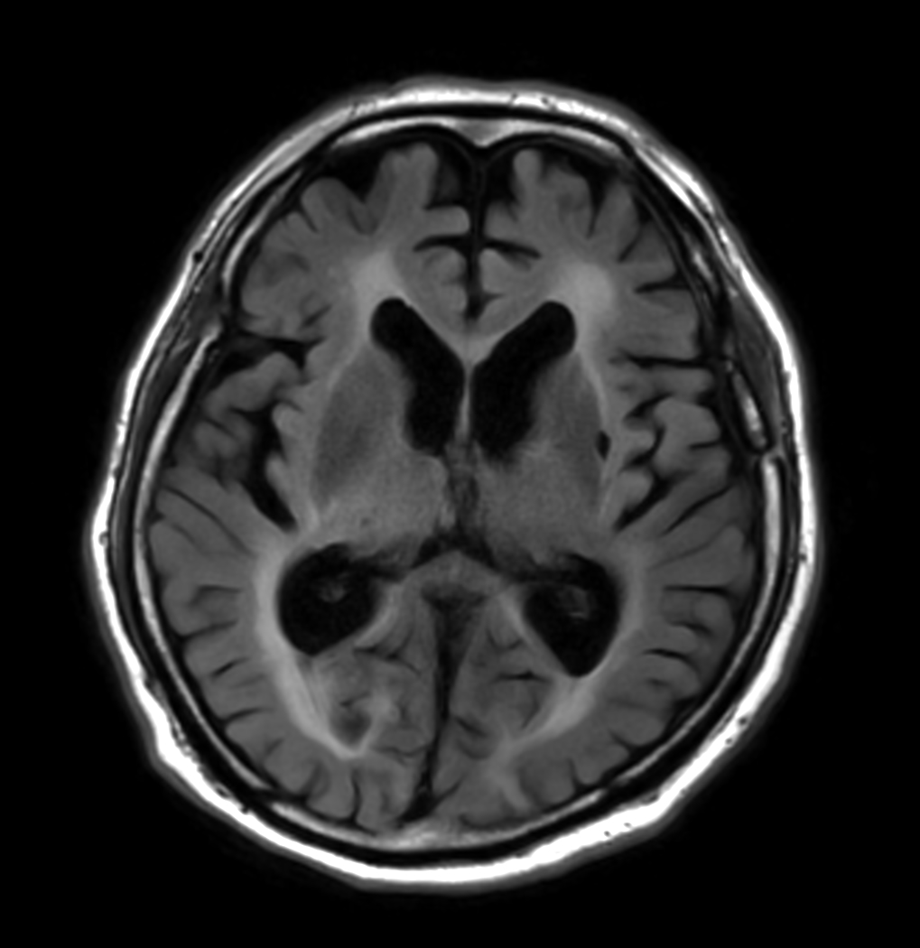 T2w FLAIR - MultiVane XD