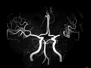 3D Inflow (MIP)