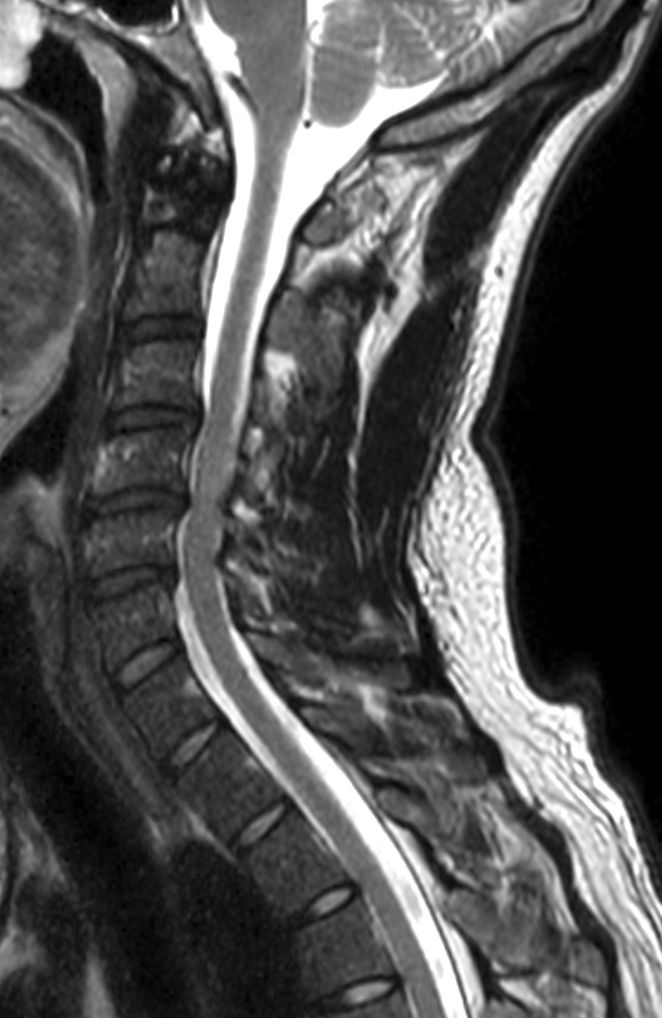 T2w TSE mDIXON XD (In Phase)