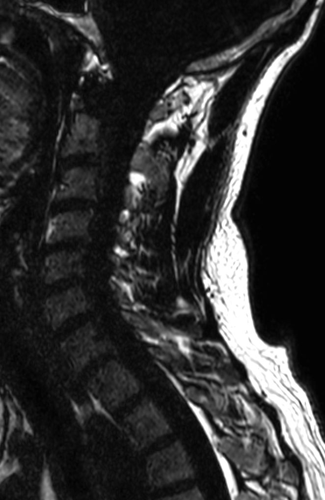 T2w TSE mDIXON XD (Fat only)