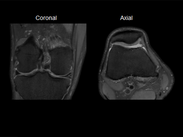 PDW SPAIR MSK View Reformats dS SENSE = 4.4