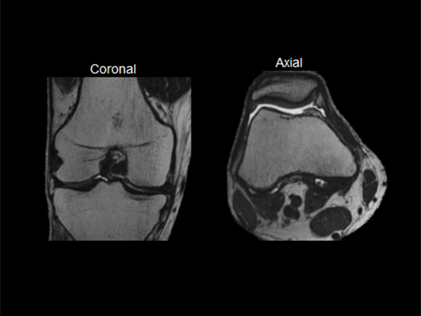 T2w MSK View - Reformats dS SENSE = 4.4