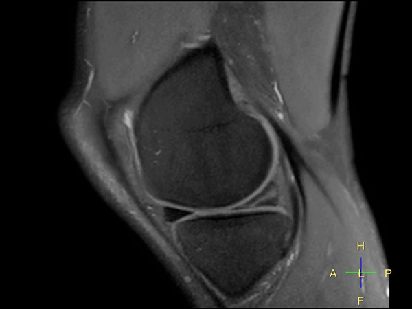 Sagittal PDW SPAIR MSK View dS SENSE = 4.4