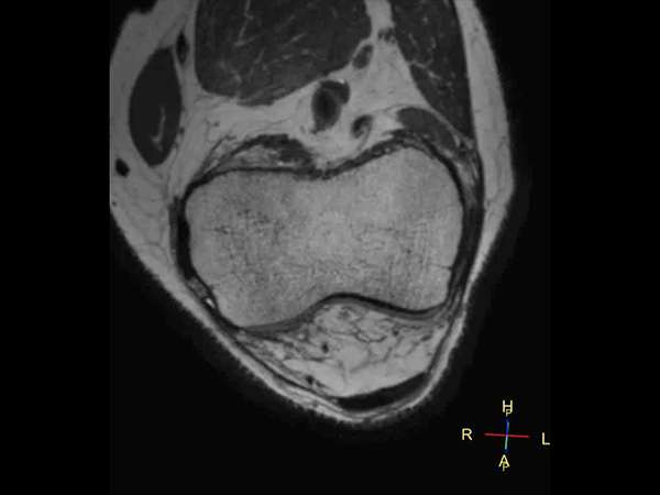 T2w MSK View (coronal reformat) dS SENSE = 4.4 