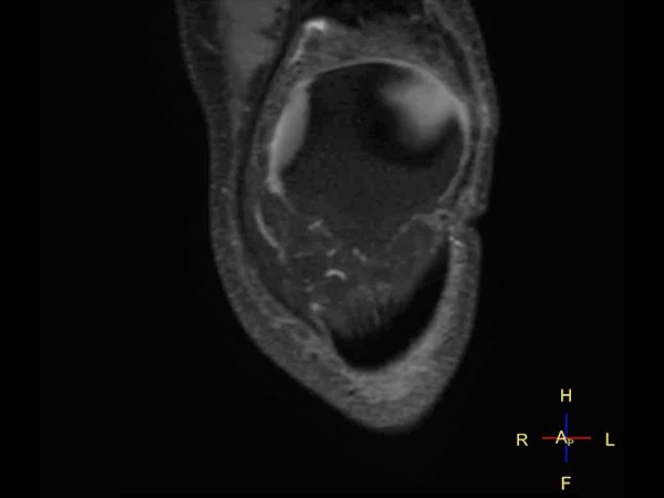 PDw SPAIR MSK View (coronal reformat) dS SENSE factor 4.4